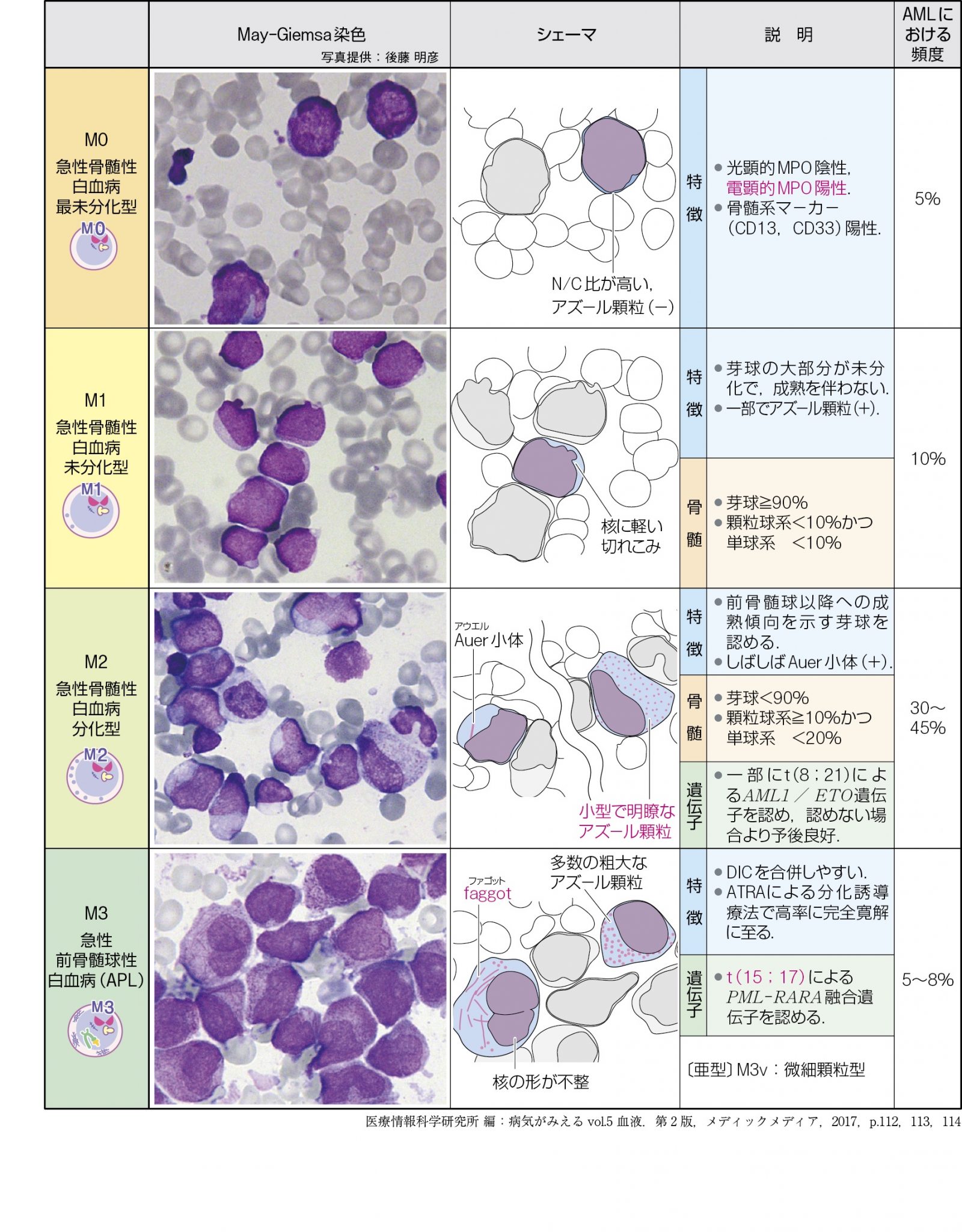 AML（急性骨髄性白血病），ALL（急性リンパ性白血病）のFAB分類 ｜臨床検査技師になろう！｜国家試験対策に役立つ情報をお届け